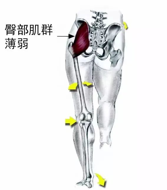 臀肌失忆症